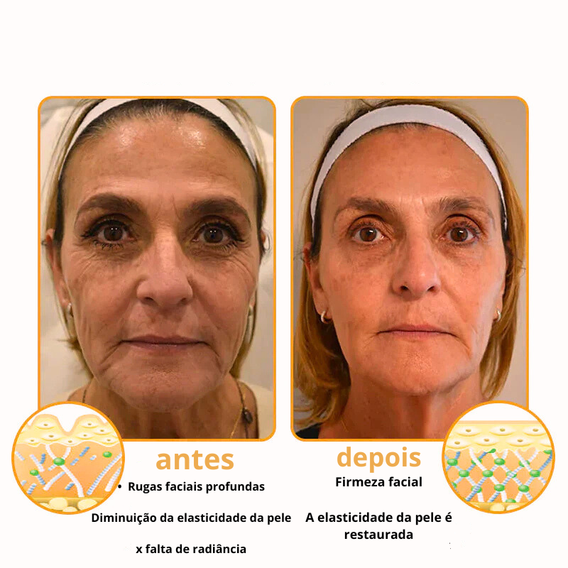 Creme Remoção de Rugas com Botox e Veneno de Abelha