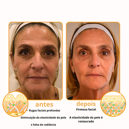 Creme Remoção de Rugas com Botox e Veneno de Abelha