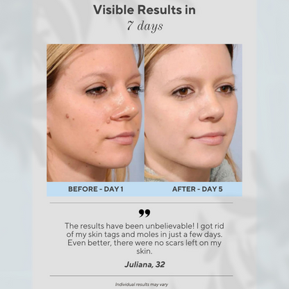 Caneta Removedora de Imperfeições da Pele 6 em 1