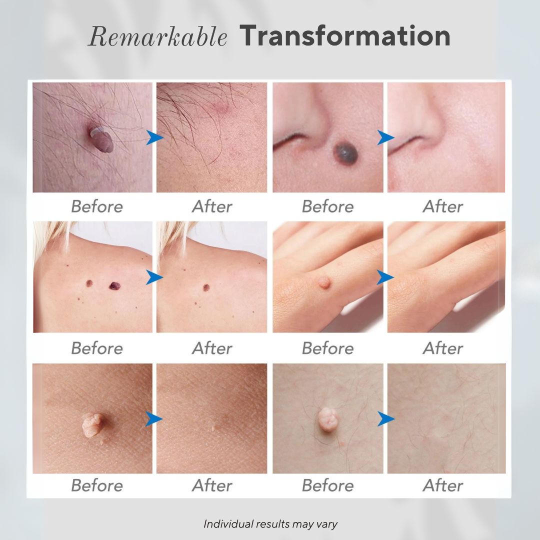 Caneta Removedora de Imperfeições da Pele 6 em 1